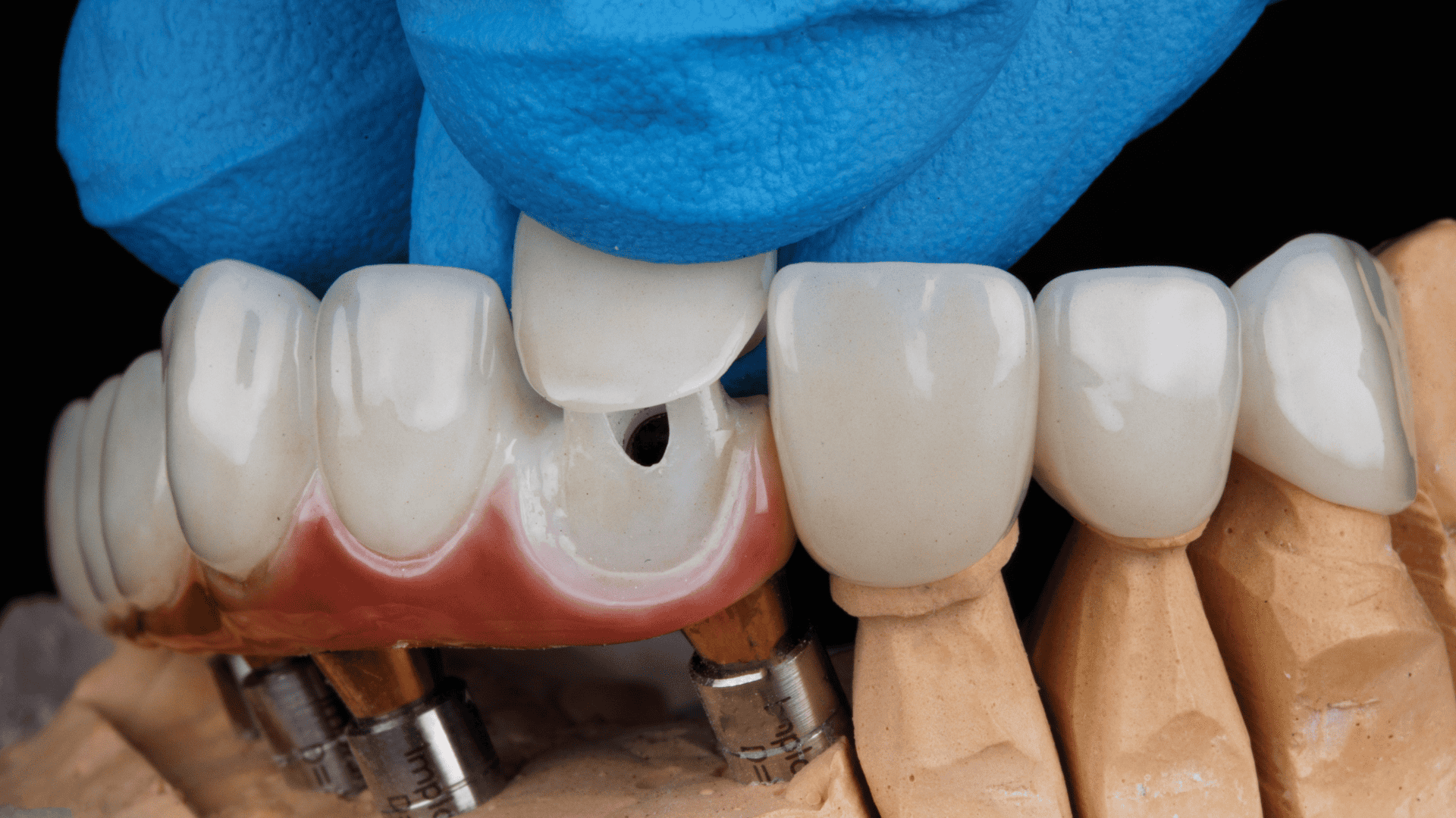Dental Crown Showing an example of how it's used to restore smiles.