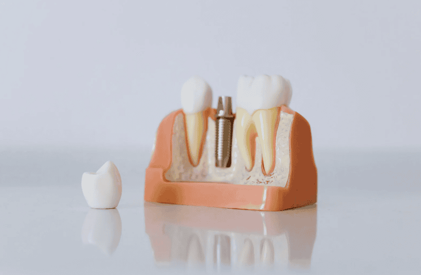 Dental Implants in Littleton CO