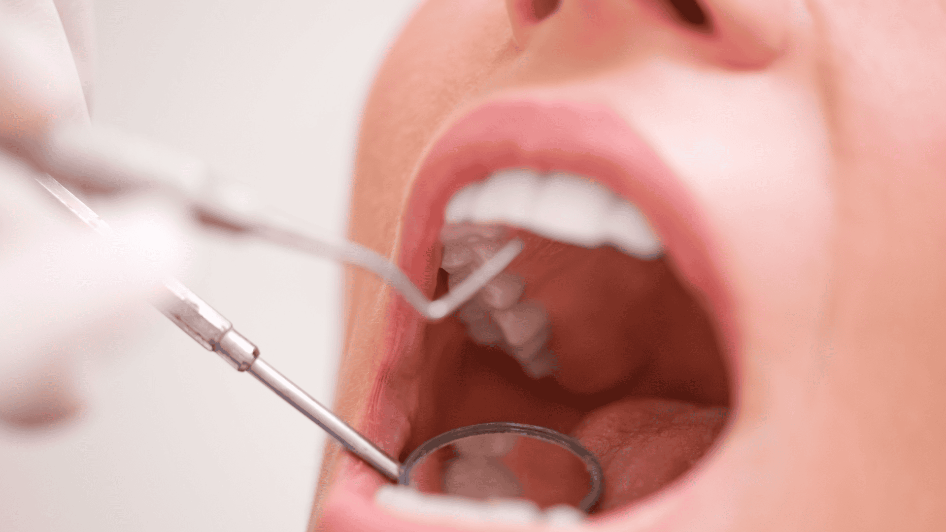 Dental Bonding at Little Family Dental in Littleton Colorado