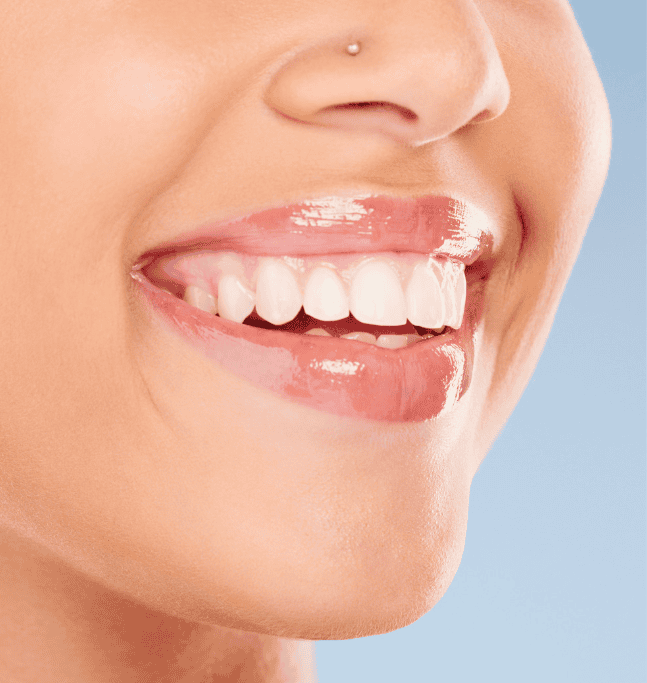Dental Veneers in Littleton Colorado - Littleton Family Dental