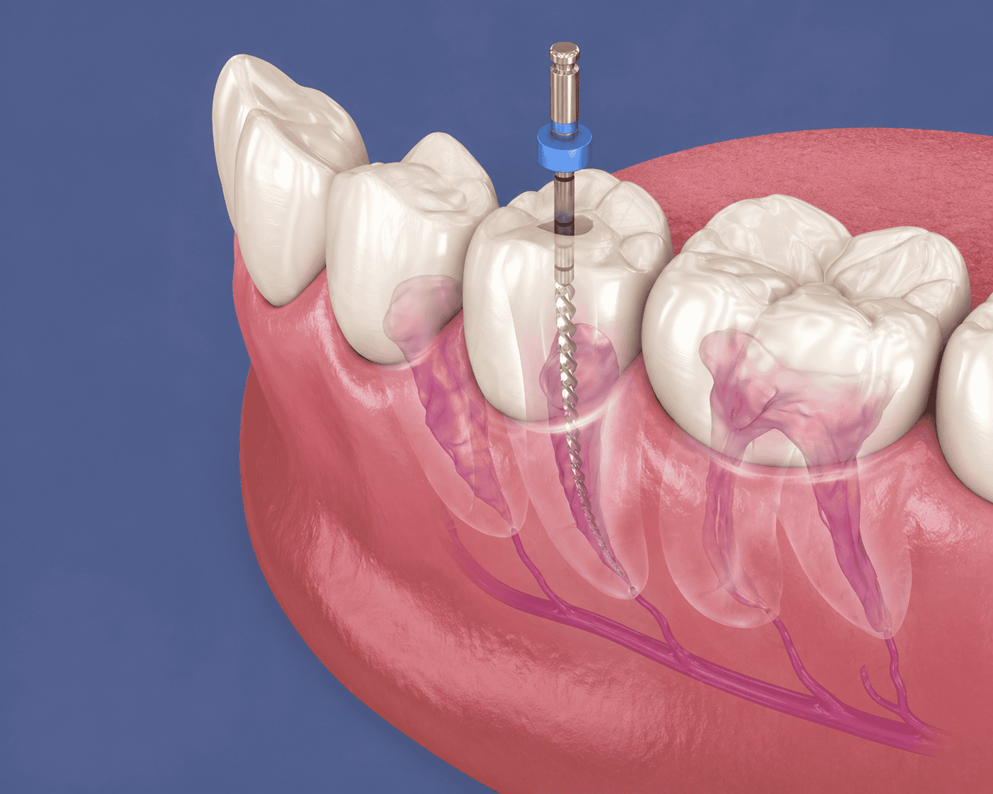 Root Canal Treatment in Littleton Colorado