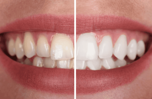 Teeth Whitening Before and After Littleton Colorado - Littleton Family Dental