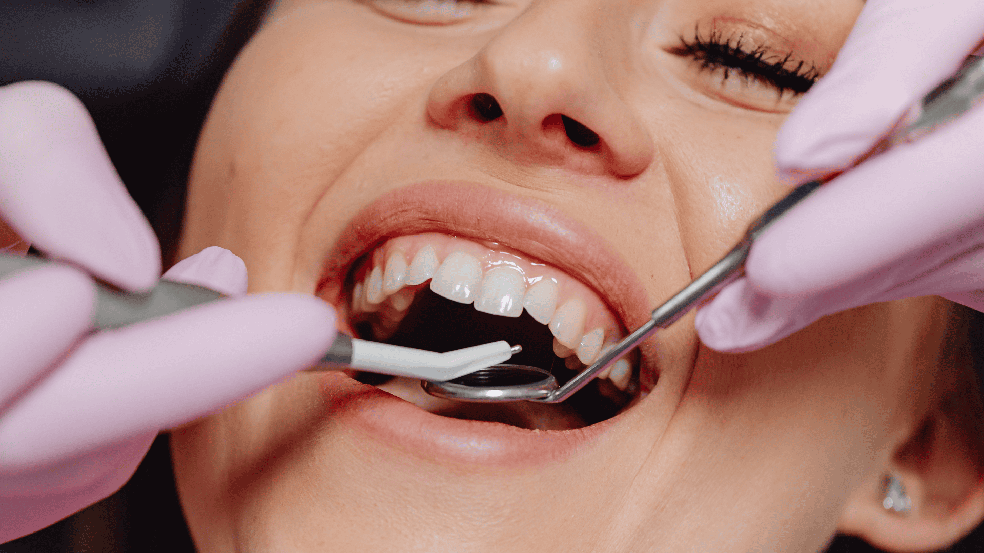 Gentle Tooth Extractions in Littleton Colorado