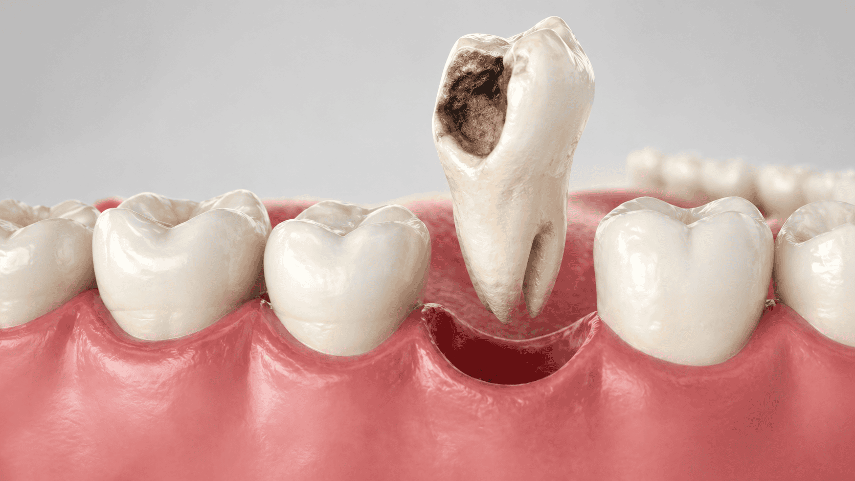 Tooth Extractions For Infected Teeth/Bad Teeth