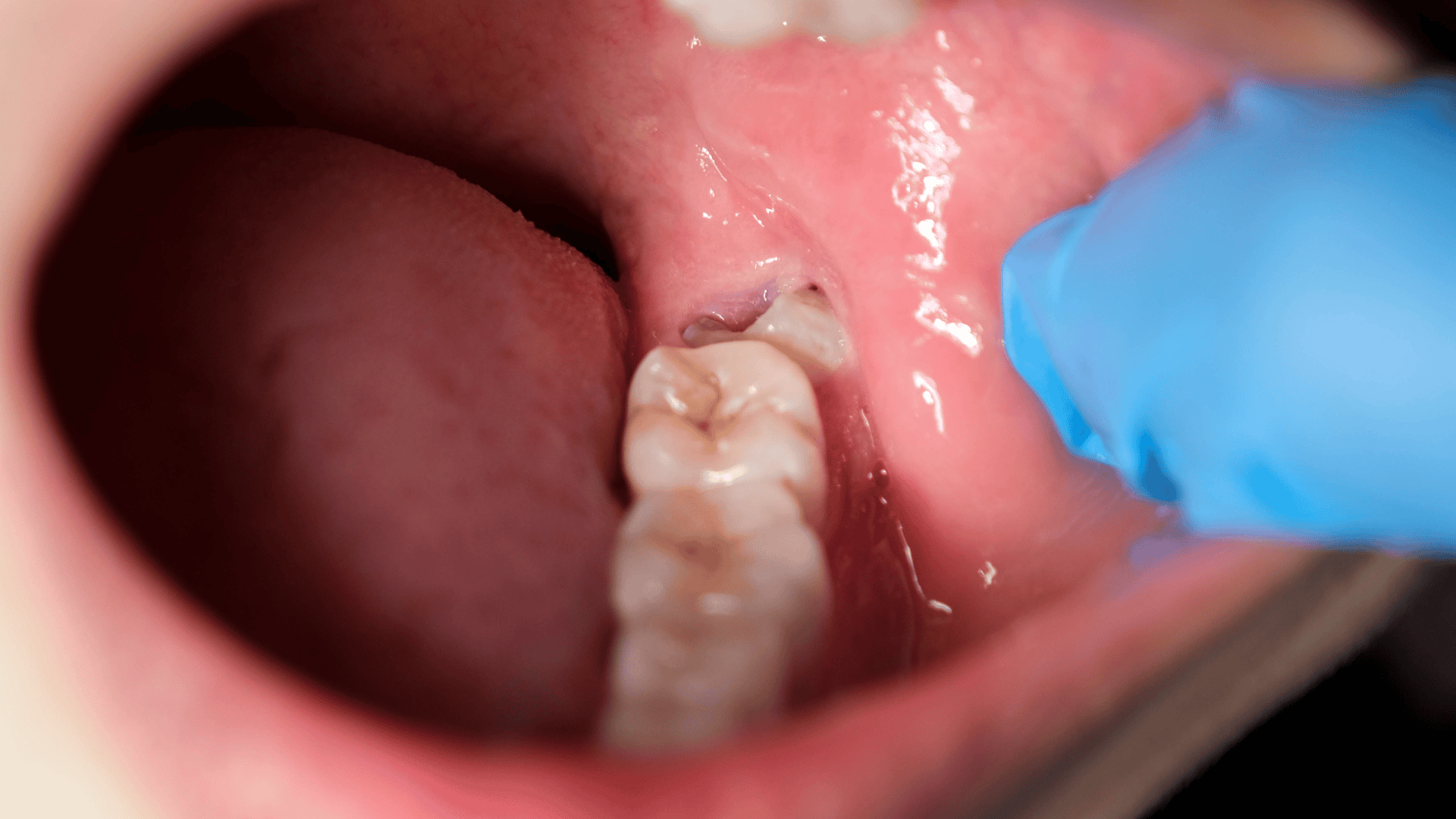 Wisdom Teeth Extractions In Littleton CO - Littleton Family Dental