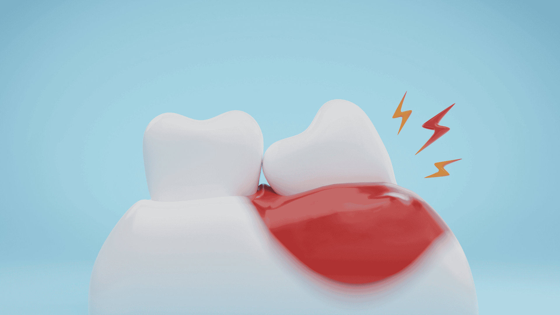 Wisdom Teeth Extractions In Littleton CO