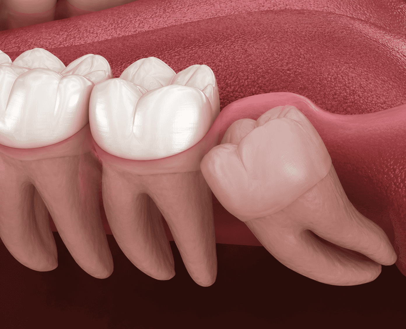 Wisdom Teeth Extractions In Littleton CO - Littleton Family Dental