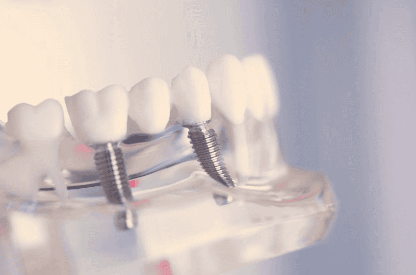 Dental Bridge In Littleton CO
